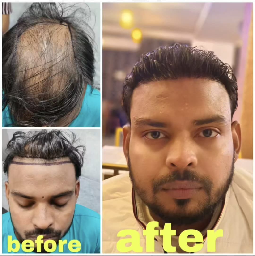 Before and After Full Beard Restoration