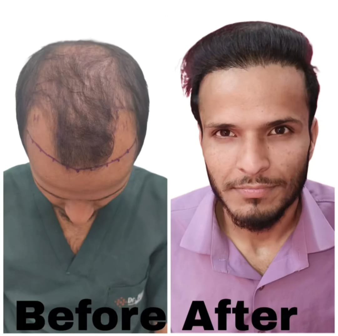 Before and After Temple & Frontal Rebuild