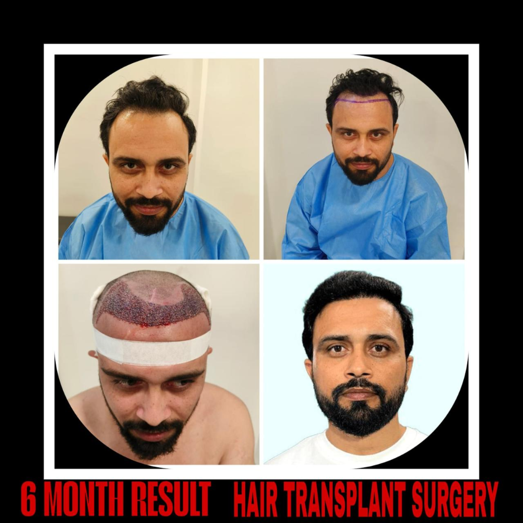 Hair Transplant Before After Result - Full Hairline Transformation