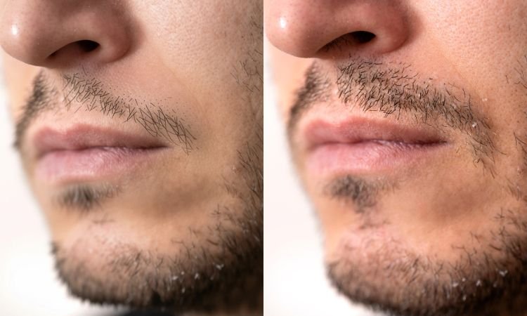 Moustache Transplant