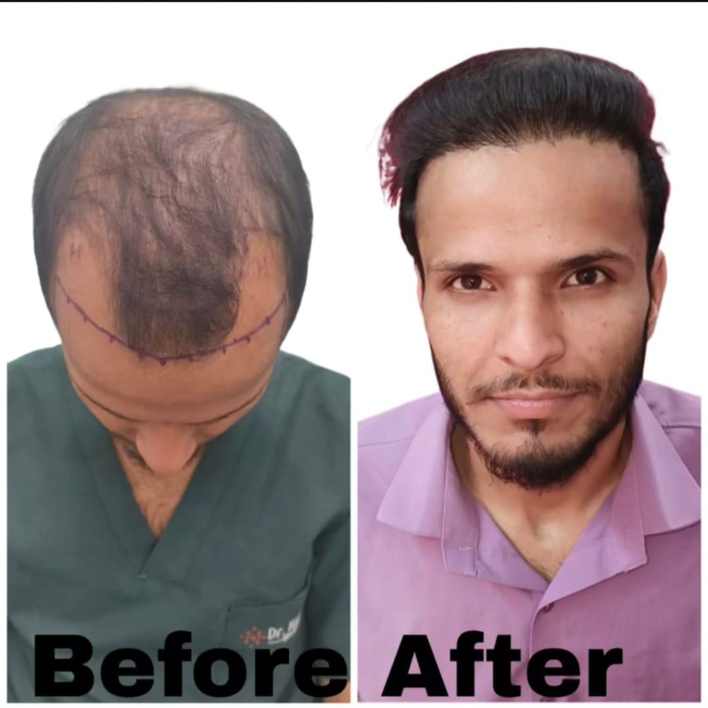 Hair Transplant Treatment: DHT (Direct Hair Transplant) <span class=